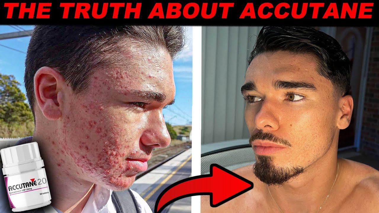 IS ACCUTANE WORTH IT - My Acne Journey