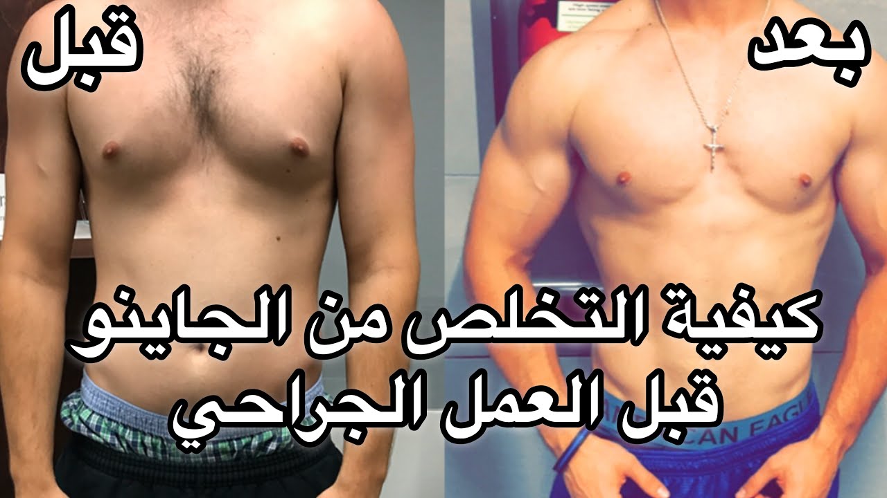 كيف تتخلص من التثدي ( الجاينو )