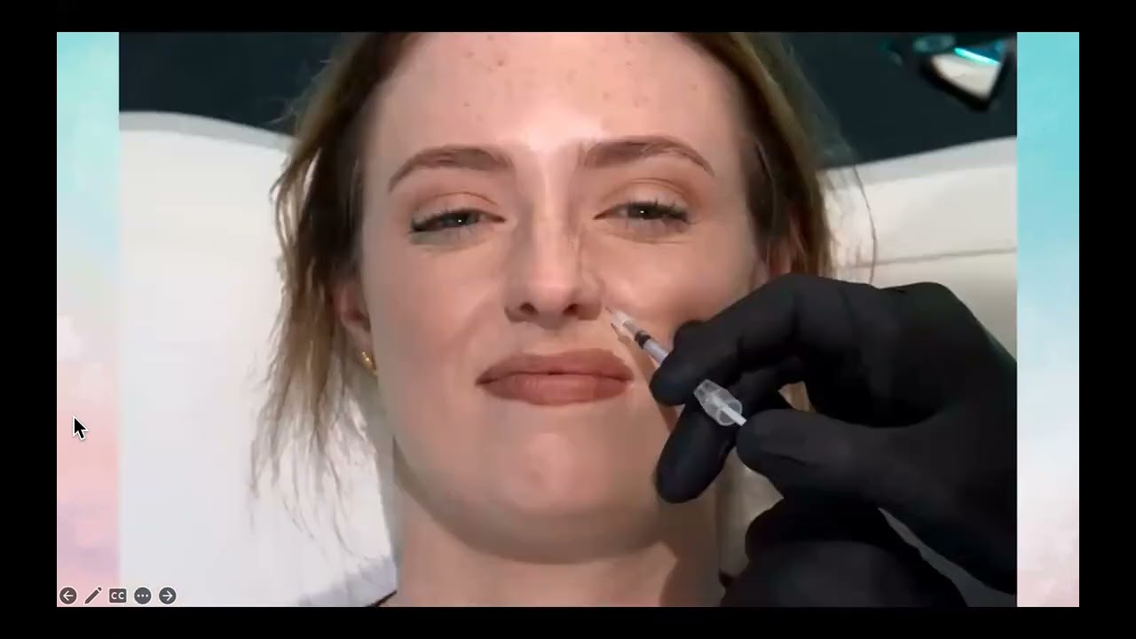 Gummy Smile BTX حقن الضحكة اللثوية بالبوتوكس