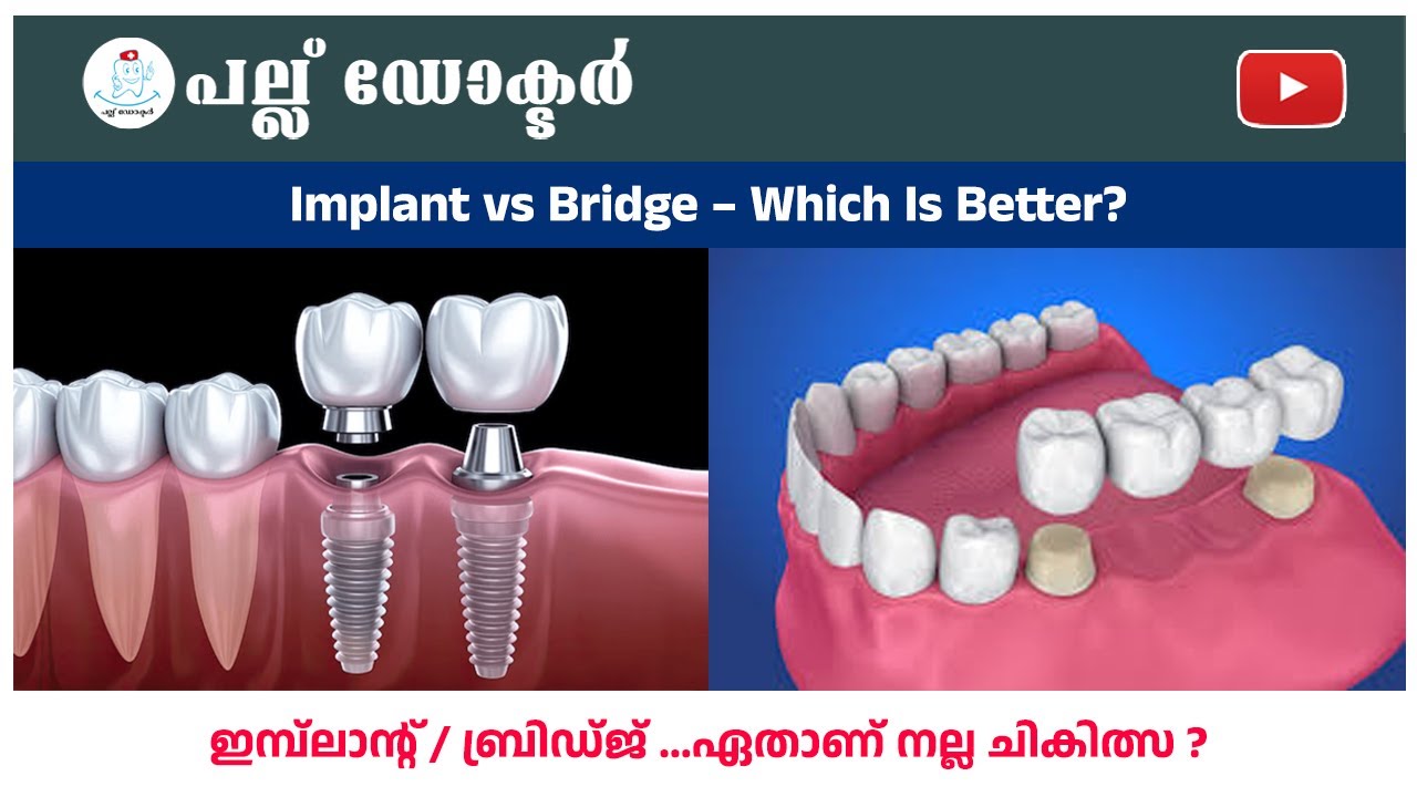 ഇമ്പ്ലാന്റ് vs ബ്രിഡ്ജ് – ഏതാണ് നല്ല ചികിത്സ? / Implant vs Bridge – Which Is Better? | Pallu Doctor