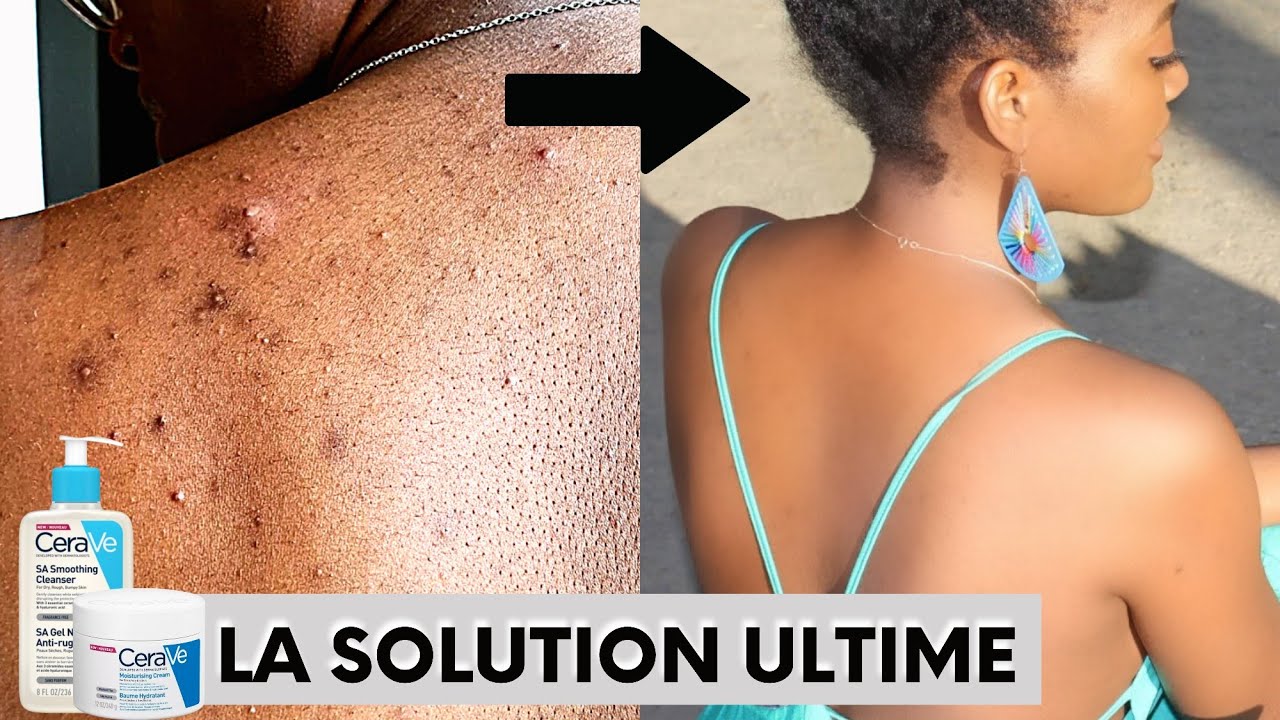 L' ACNÉ DU DOS: COMMENT s'en DEBARASSER? 2 PRODUITS MOINS CHERS!🔥| FINI les BOUTONS & les TÂCHES