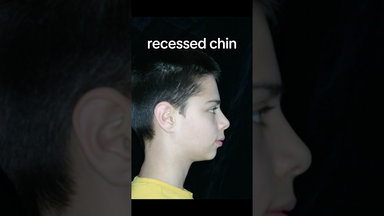 how to fix your recessed chin #looksmax #glowup