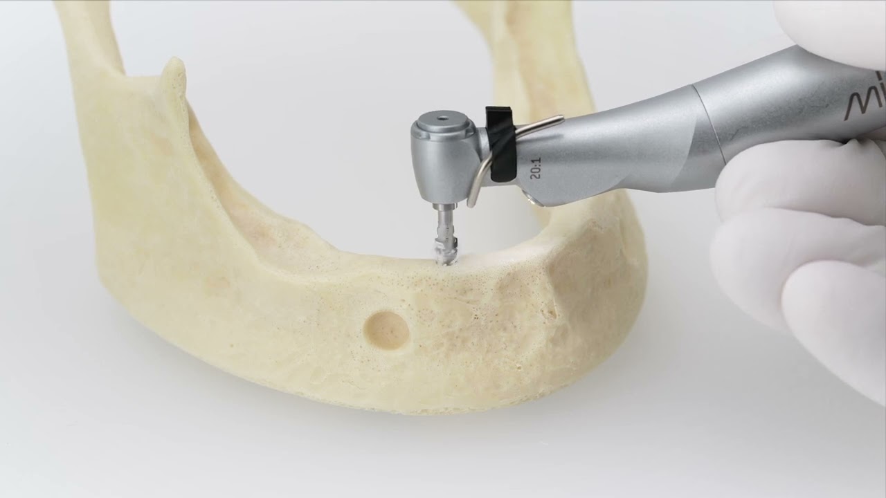 How to Place a &Oslash;4.2x13 mm SEVEN XD Dental Implant