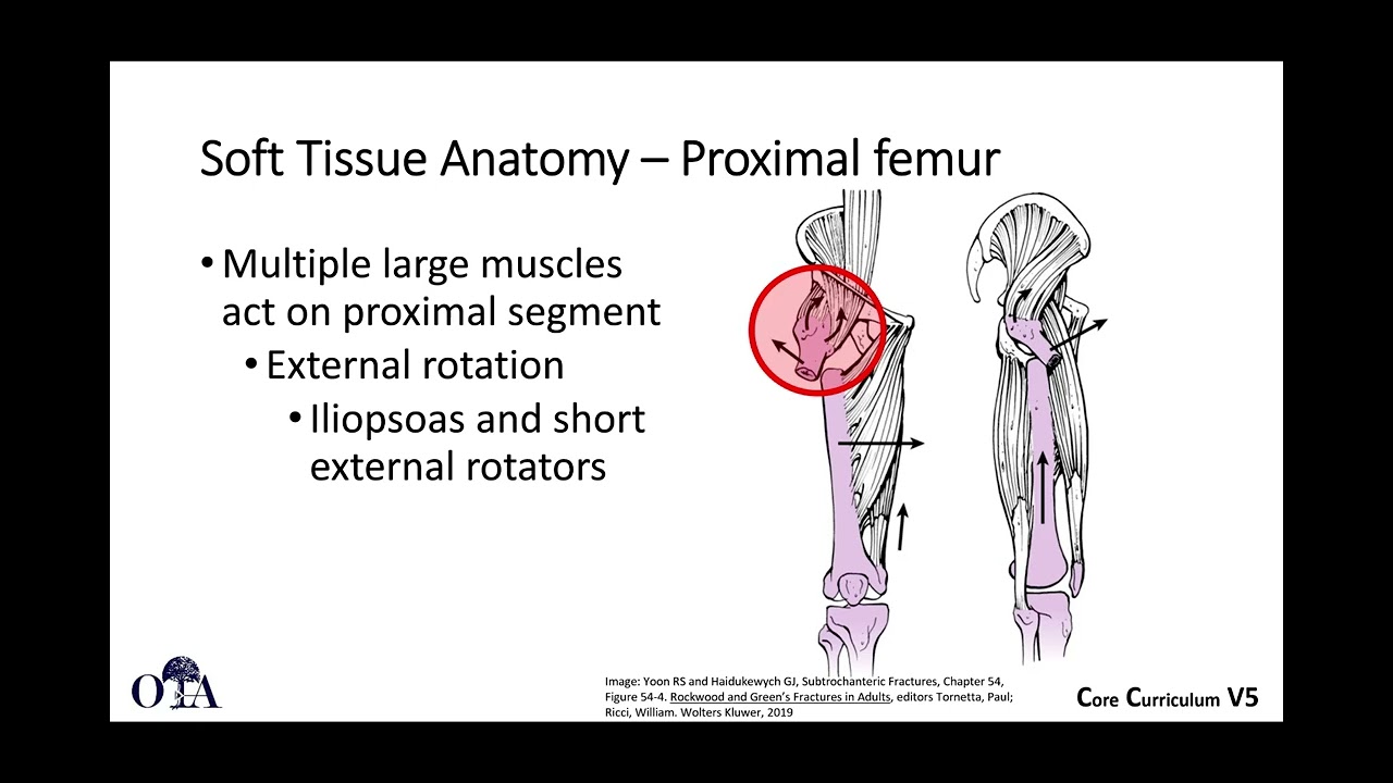 Subtrochanteric femoral fractures - 1 of 3