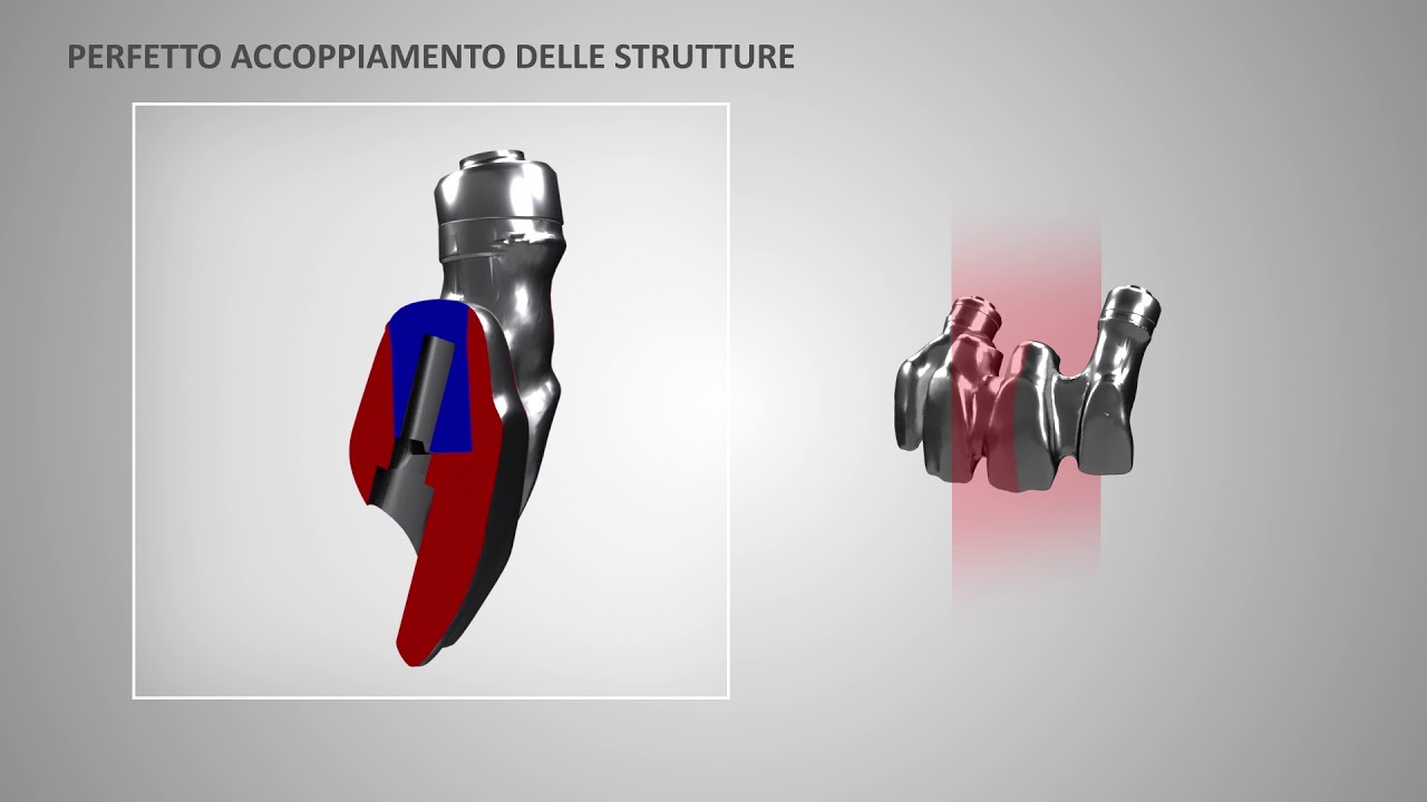 twOne: la rivoluzione in protesi avvitata