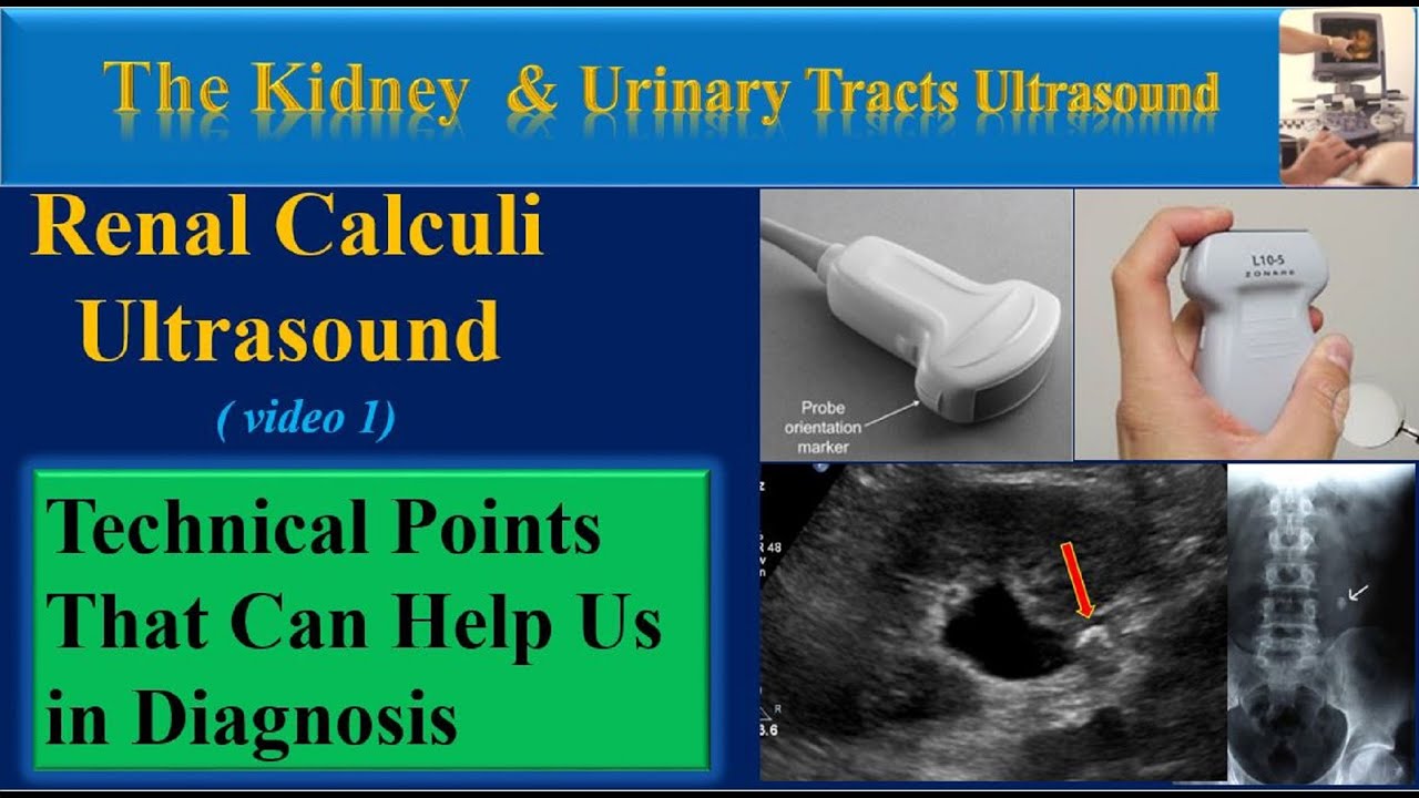 Renal Stone Ultrasound , Technical Points That can Help us in Diagnosis