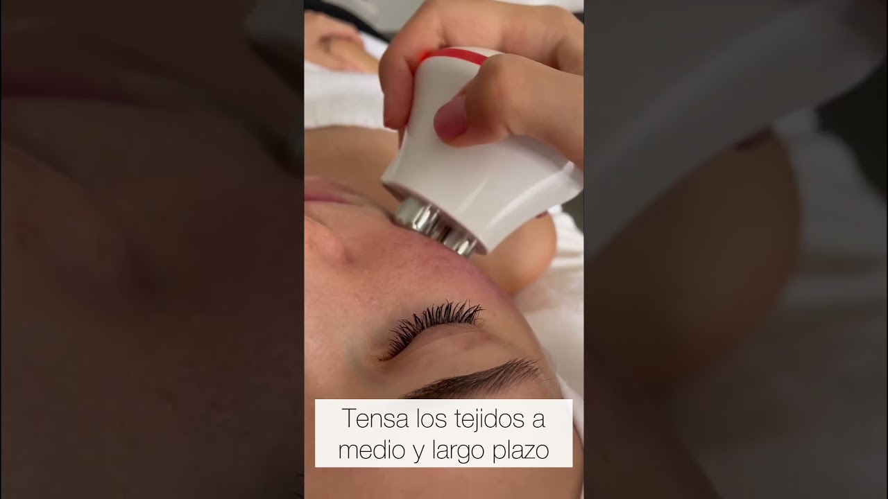 Radiofrecuencia Facial
