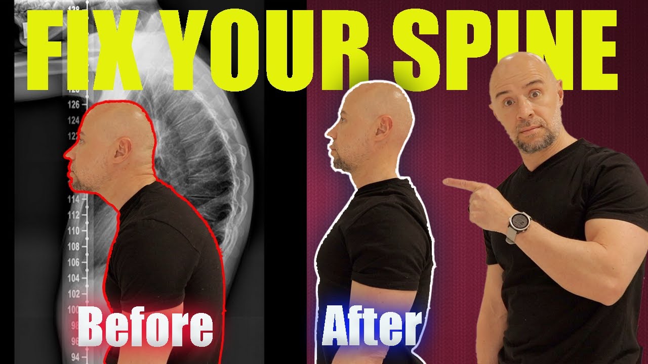 Hyperkyphosis Destroying Your Posture? Try This