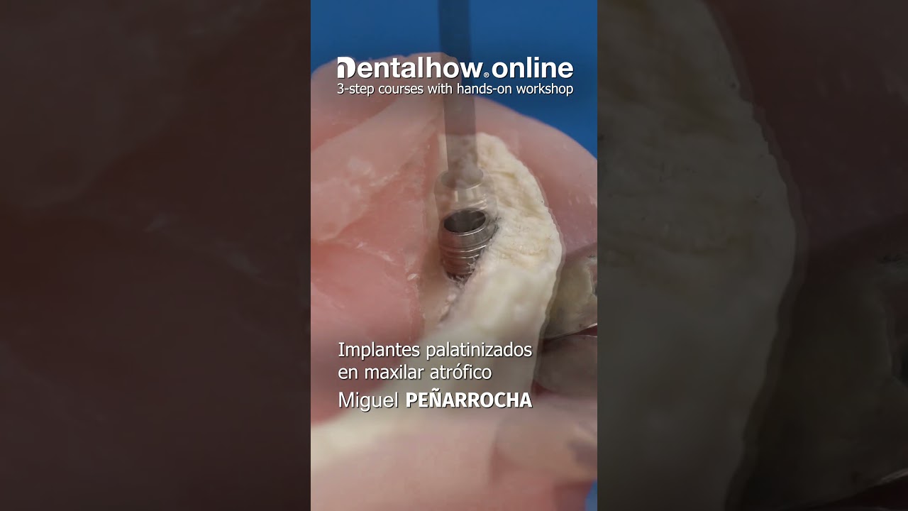 Dr. Pe&ntilde;arrocha | Curso Online Colocaci&oacute;n Implantes Palatinizados | 2024 #shorts #dentista #cirugia