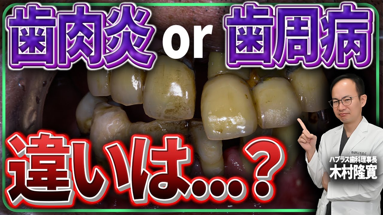 【完全版】歯周病が治らなくなる手遅れのタイミングとは...？歯肉炎と歯周病は何が違うのか現役の歯医者が専門的に徹底解説させていただきます