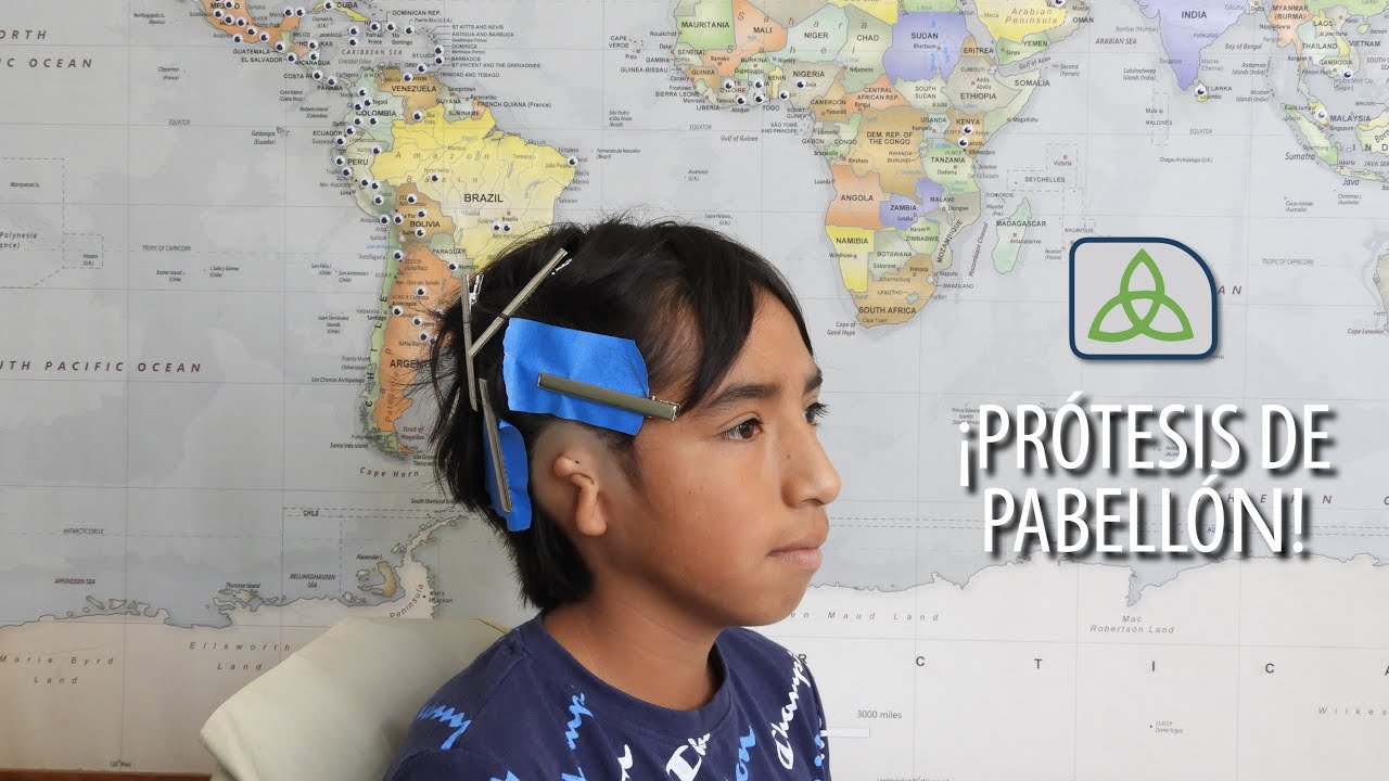 Microtia, solución sin cirugía No. 261