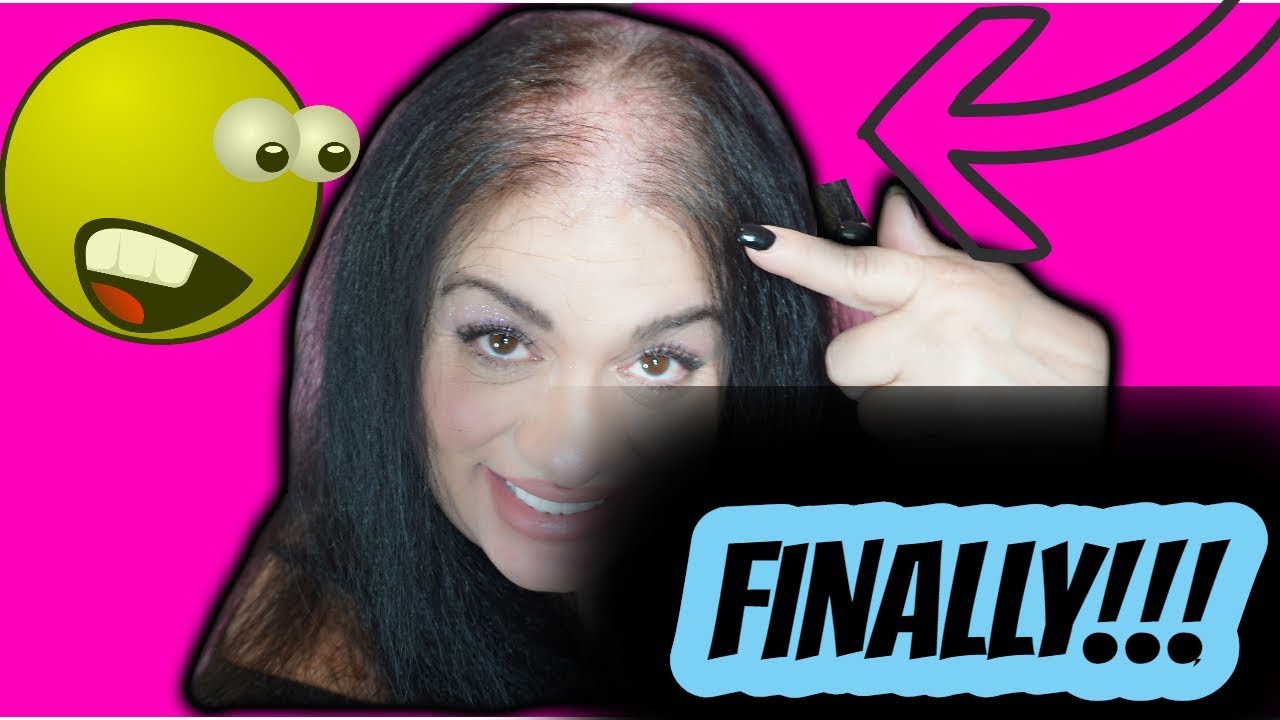 I FINALLY REVEAL MY SEVERE HAIR LOSS TO THE WORLD | MY FAMILY DIDN'T EVEN KNOW!