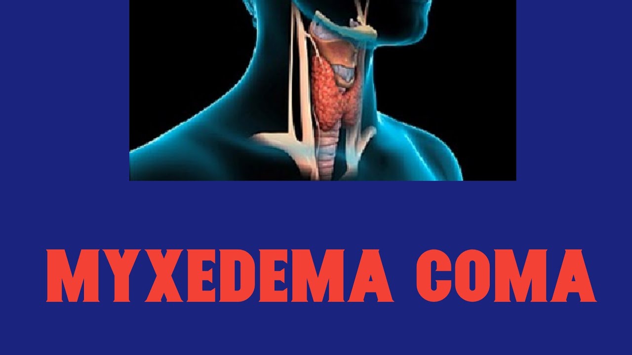 Myxedema coma || Hypothyroidism
