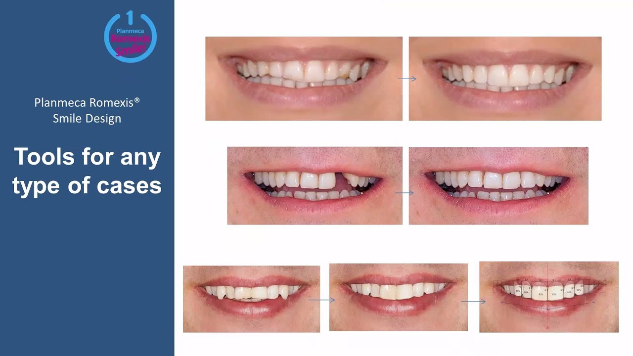 Planmeca Romexis® Smile Design Webinar – how to design realistic smiles