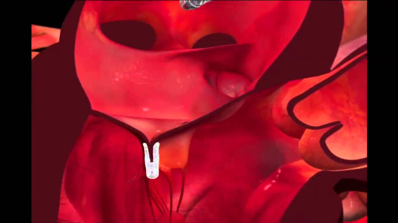 Leaky heart valve clip video