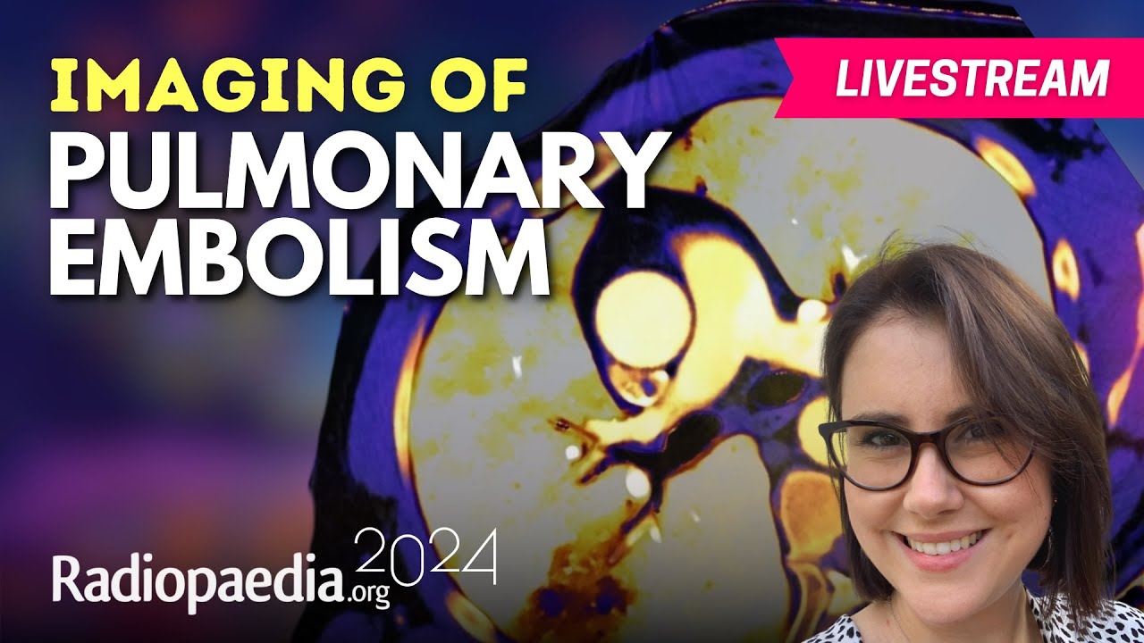 Imaging of Pulmonary Embolism with Sally Ayesa