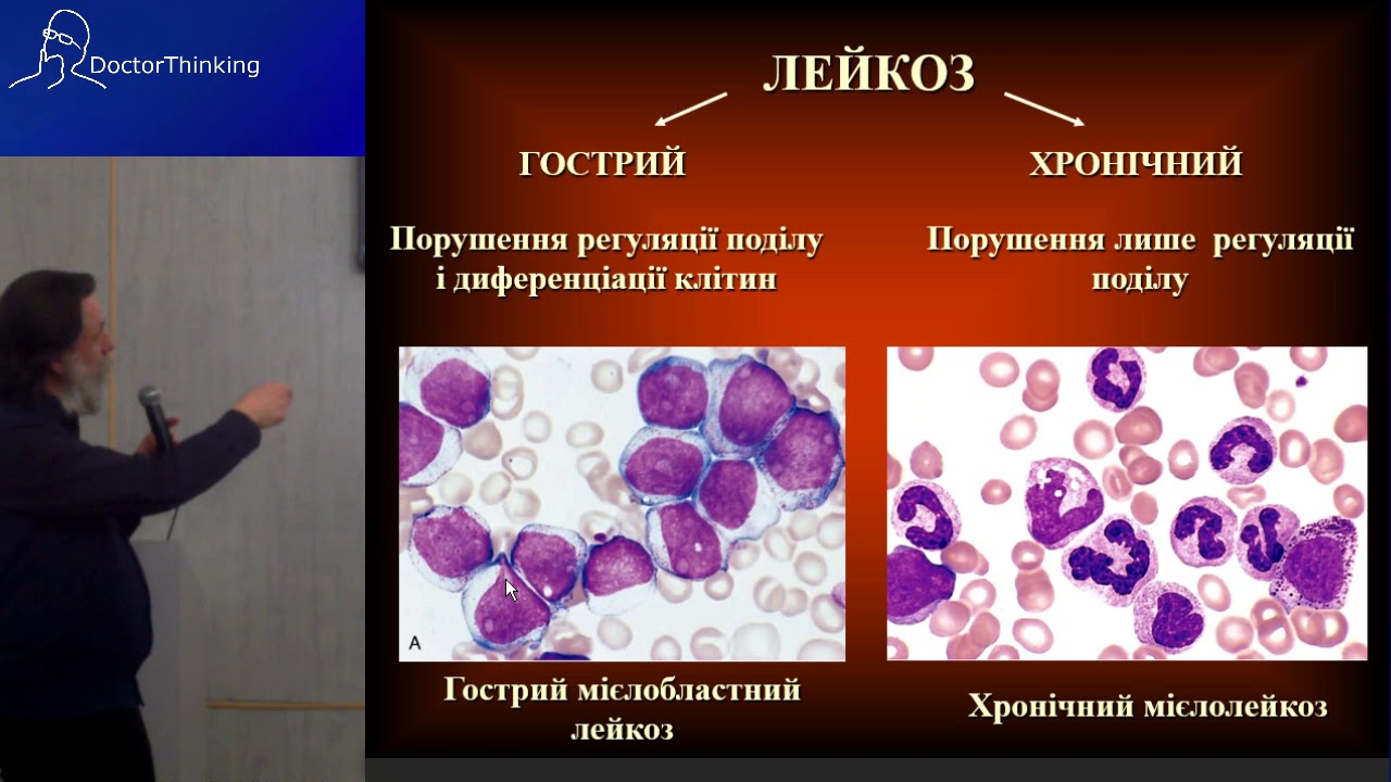 Гемобластози - Віктор Досенко