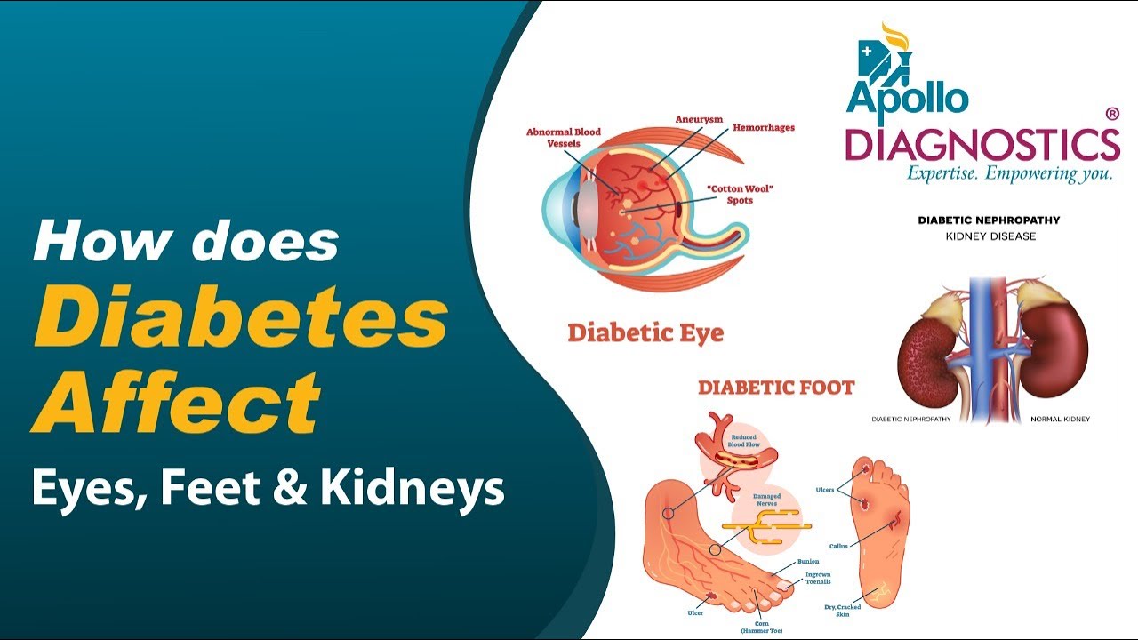 How does Diabetes affect Eyes, Feet, and Kidneys || Apollo Diagnostics