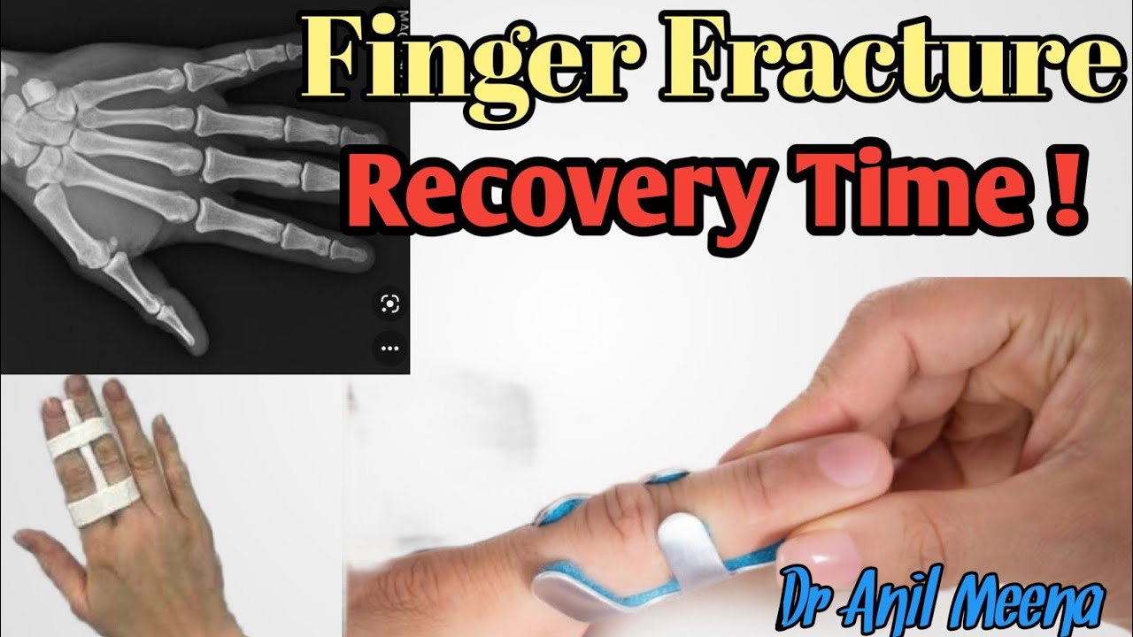 finger fracture treatment | hand finger fracture treatment home| hand phalanges fracture | in hindi