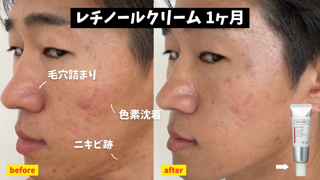 【レチノール1ヶ月経過 】効果と使い方からおすすめスキンケアの順番！