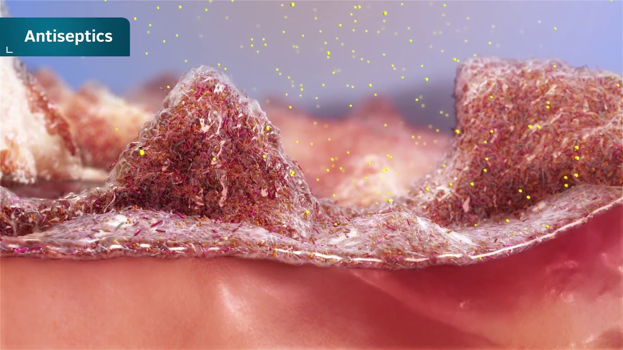 Biofilm is an enemy worth targeting - Rechtsdepesche International
