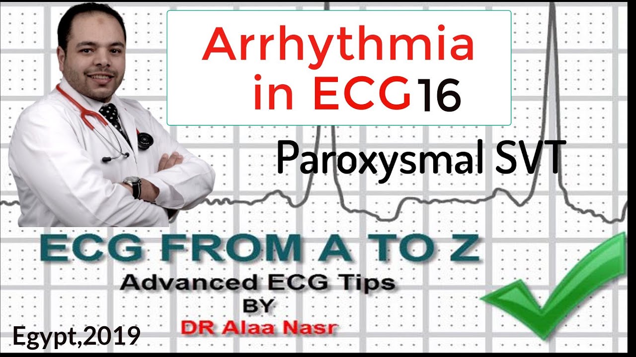 ECG from A to Z, intermediate level, Arrhythmia 16, Dr Alaa Nasr, 2019