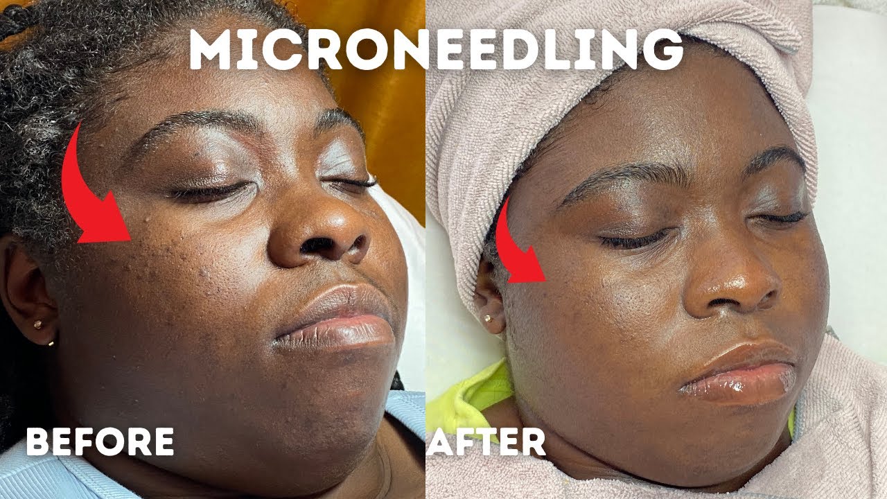 Microneedling Acne Scars | Before and After | Glam By Lia Leigh