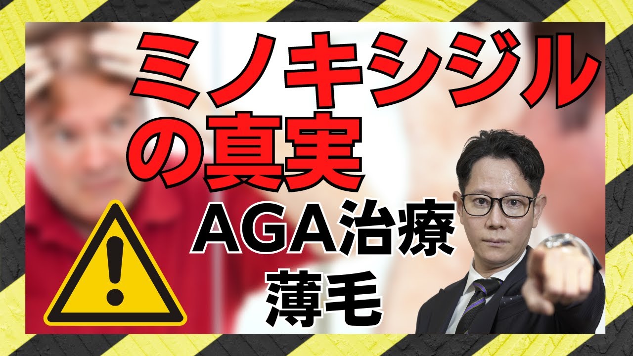 【AGA治療】ミノキシジルの真実【AGA】