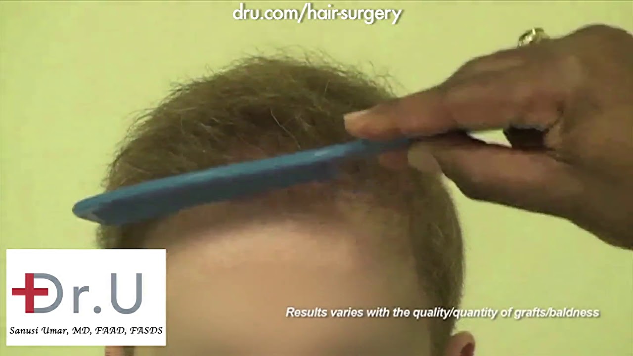 Best Body Hair Transplant in Los Angeles, with Dr.UGraft