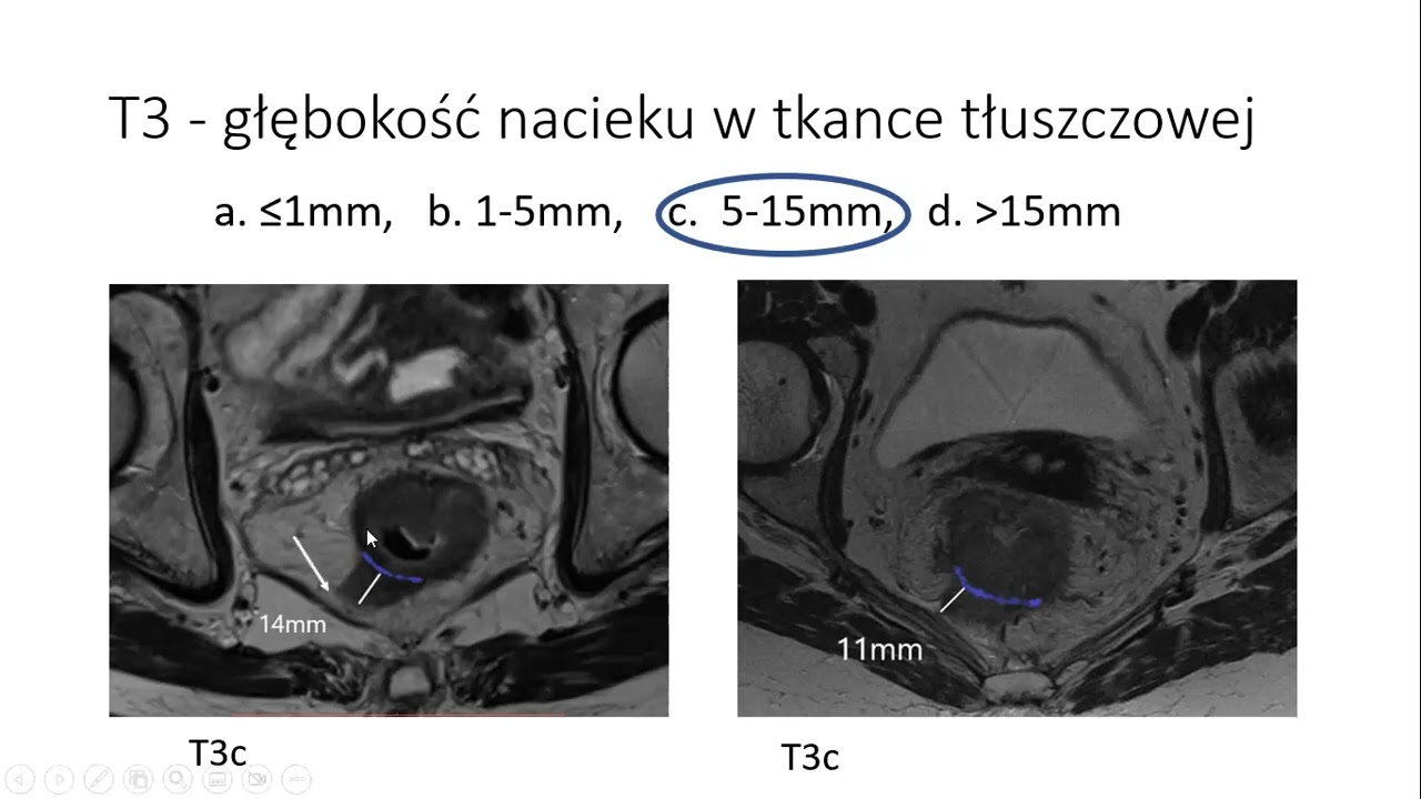 A. Hołdakowska - Diagnostyka raka odbytnicy w MR &ndash; wytyczne i zalecenia