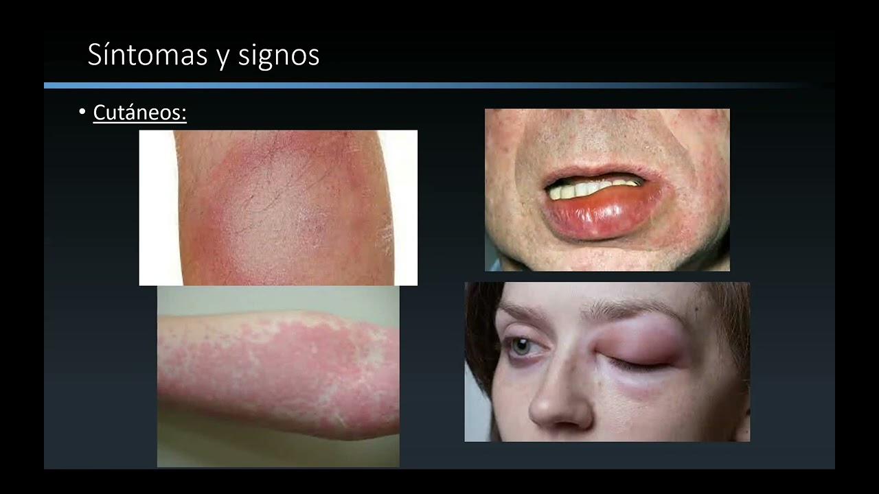 Anafilaxia y shock anafiláctico