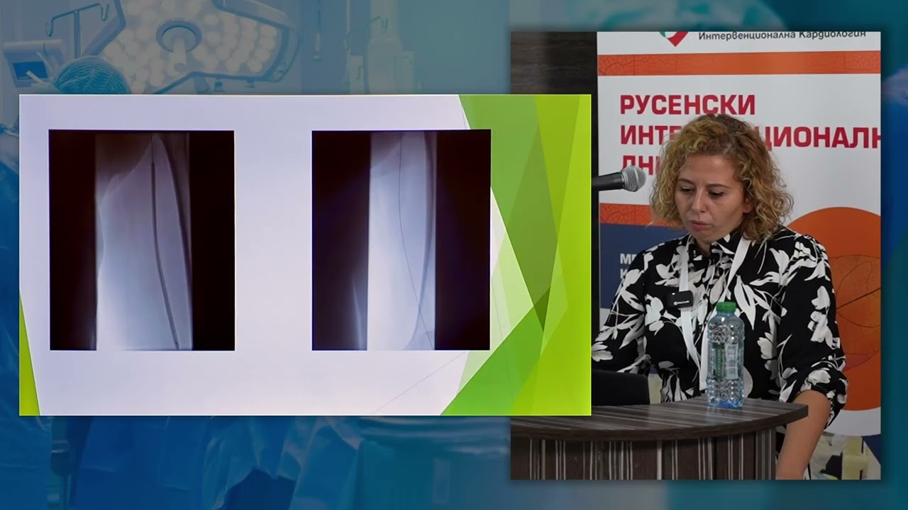 2. Хибриден метод на лечение на лезии в илeо-феморален сегмент. Клиничен опит.