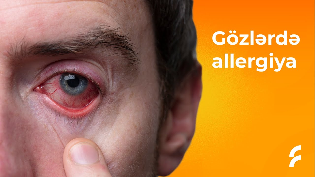 Gözlərdə allergiya | Dr. Fariz Sadiqov | 
