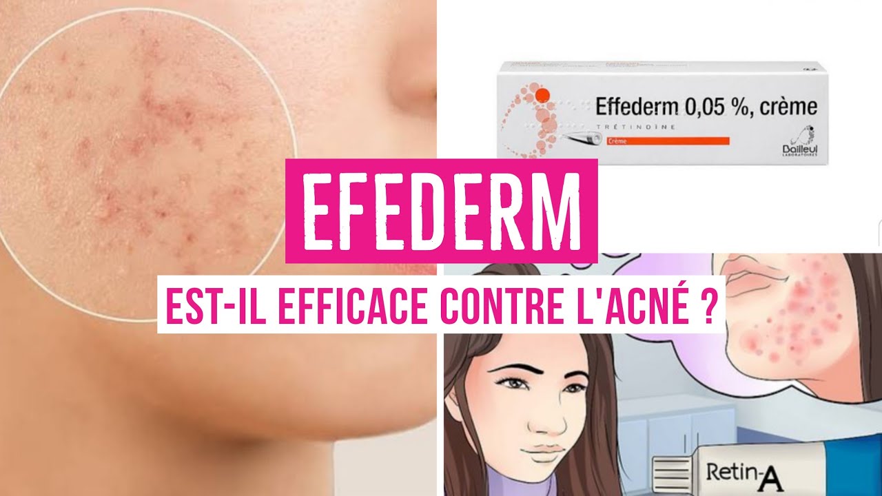 EFFEDERM 0.05 CR&Egrave;ME - TOUT CE QUE VOUS DEVEZ SAVOIRSUR CE M&Eacute;DICAMENT