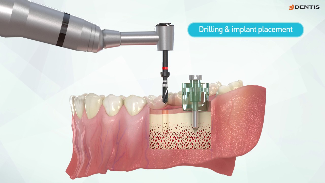 DENTIS Surgical Guide Tool - Guide Wheel
