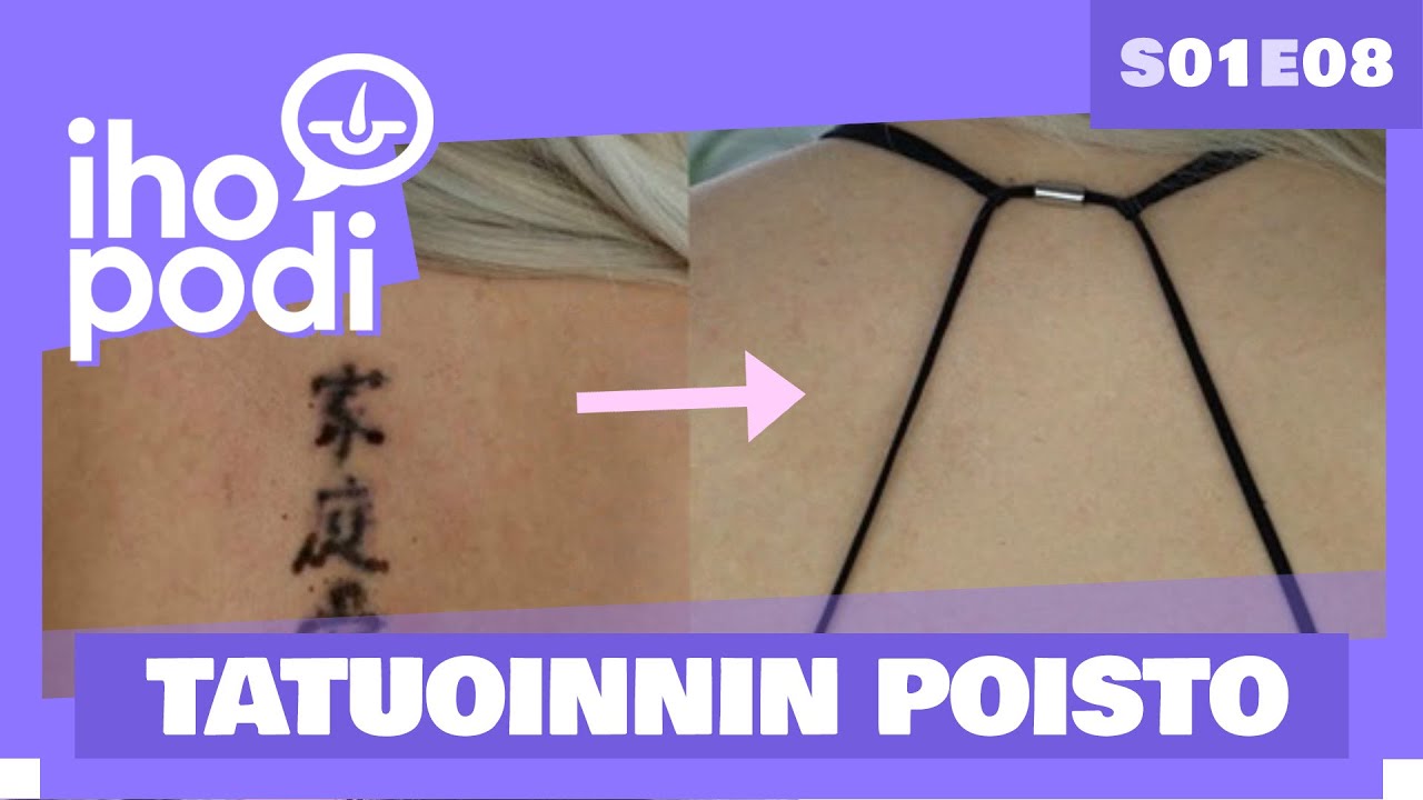 Ihopodi - S01E08 – TATUOINNIN POISTO – Vieraana Aino Viinikka