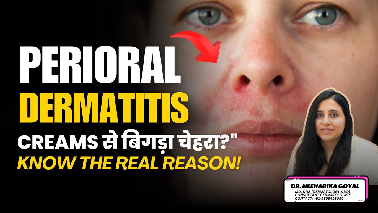 Perioral Dermatitis : Creams से बिगड़ा चेहरा? Know the Real Reason! | Dr. Neeharika Goyal