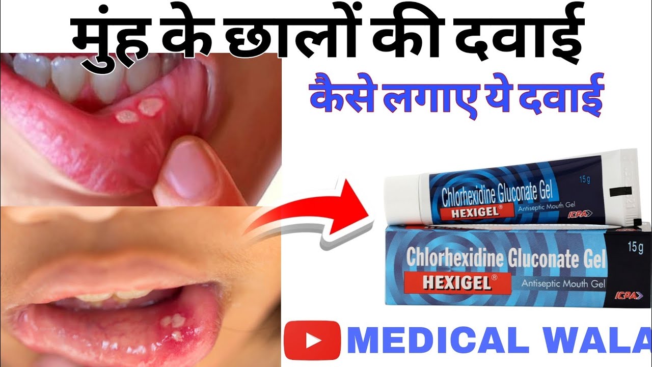 Hexigel mouth gel | hexigel antiseptic mouth gel | mouth ulcer gel | muh ke chalo ki dawai #mouth 