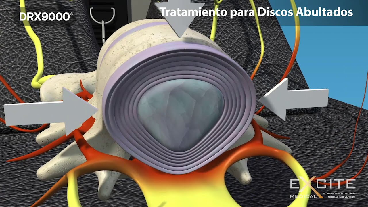 Descompresión Espinal Con La DRX9000