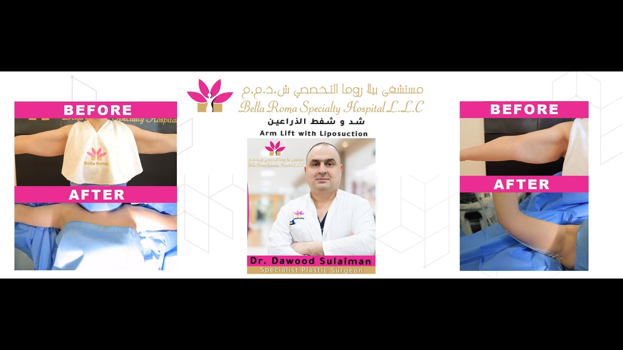 Arm Lift with Liposuction by Dr. Dawood Sulaiman