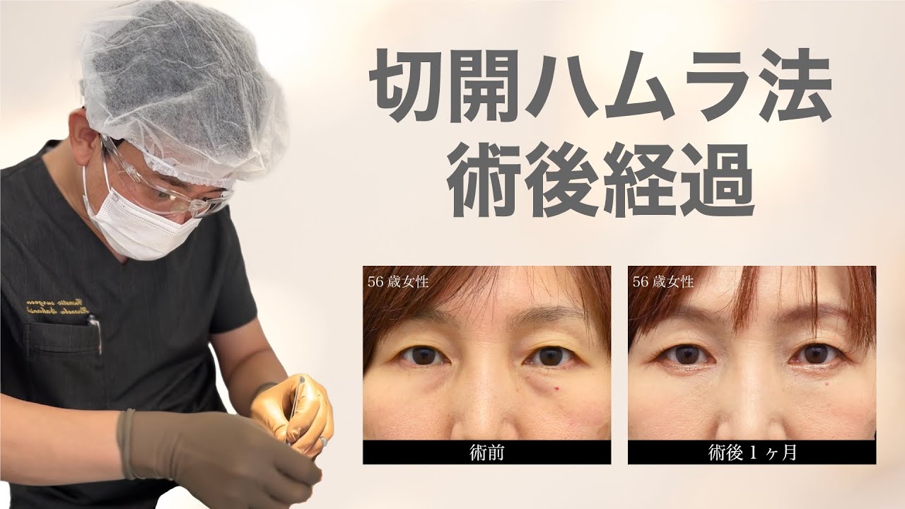 【クマ取り/切開ハムラ法】術後の経過をご紹介！