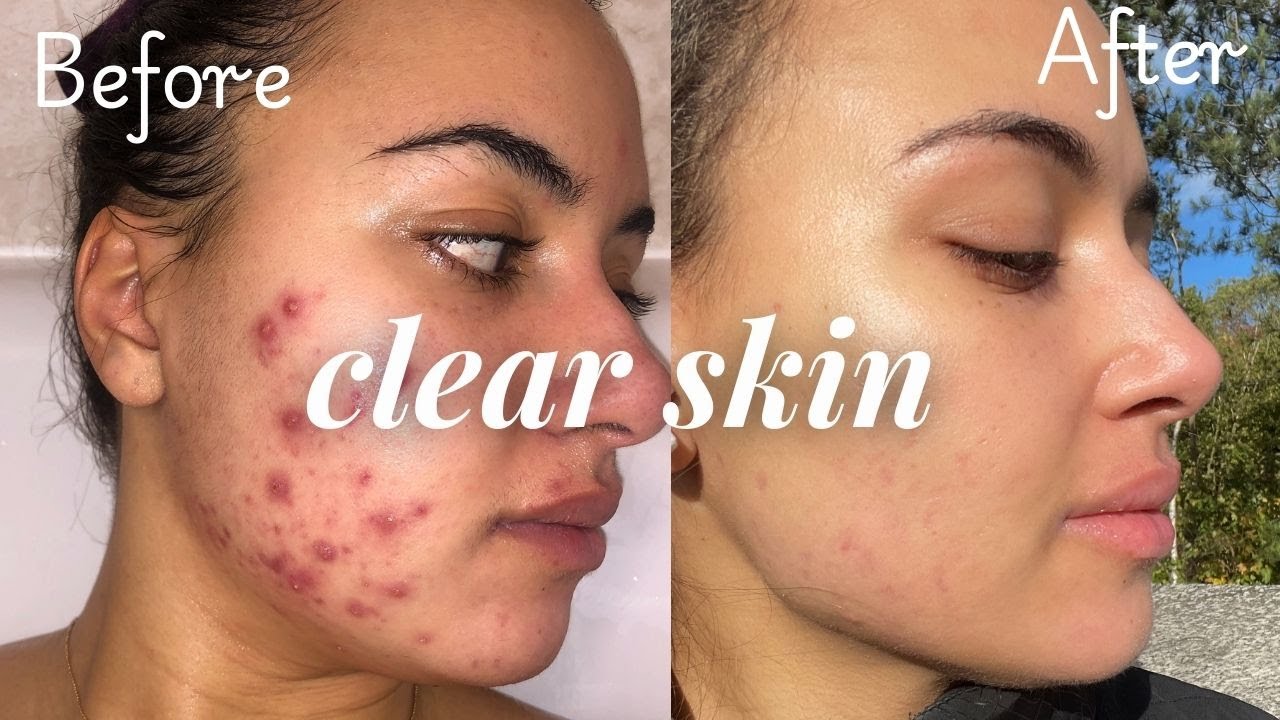 I'M BACK 🎉 How I Cleared my Skin | Evening Skincare Routine After Accutane + Life Update #clearskin