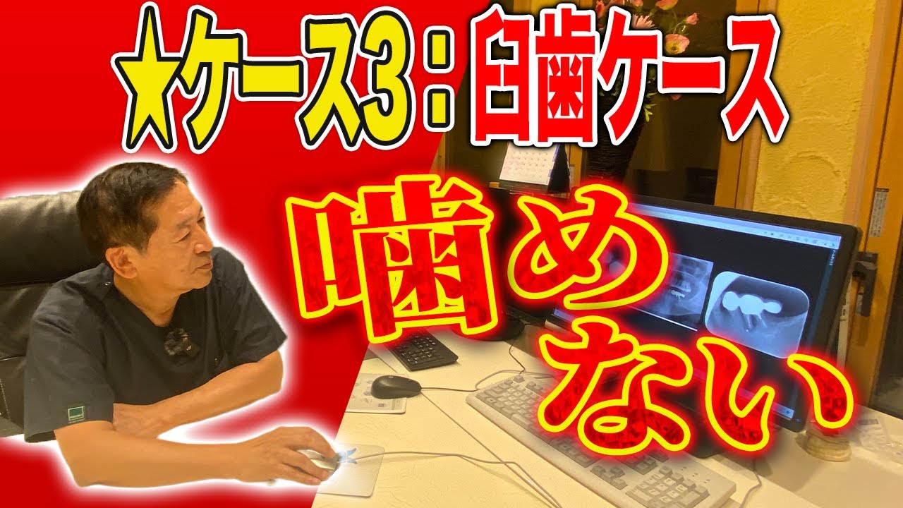 ケース3：60代男性臼歯 噛めない！有坂歯科インプラントオフィス