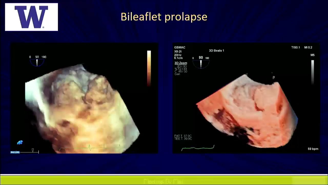 Session 1 Mitral Regurgitation Anatomic and Echocardiographic Considerations for Percutaneous and SI
