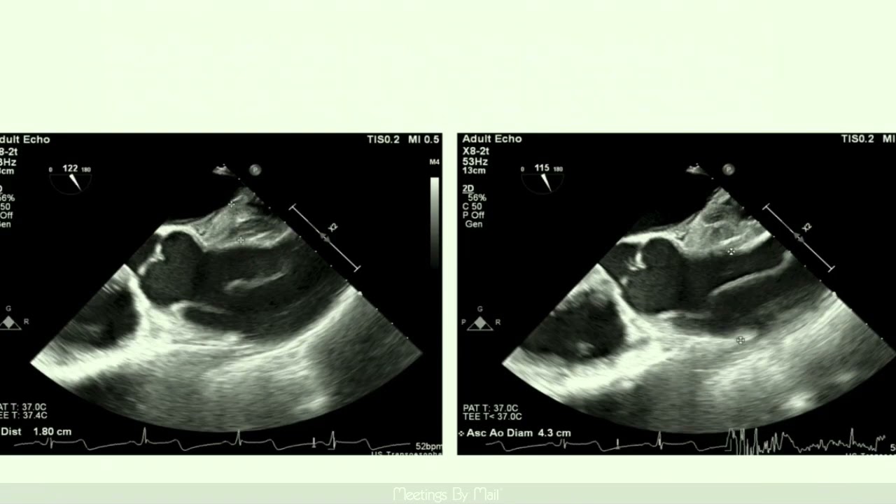 Расслоение аорты Medstudylab.com