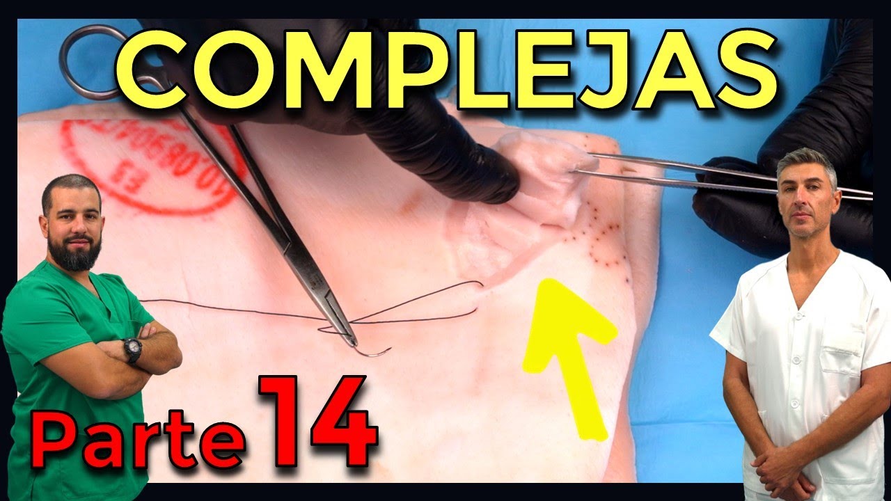 HERIDAS COMPLEJAS – CIRUGÍA MENOR y SUTURAS (Parte 14)