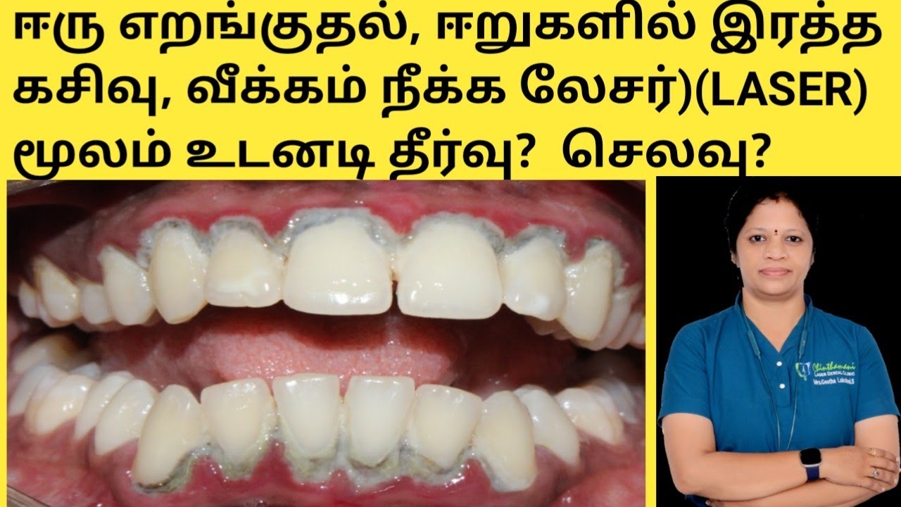 லேசர் கம் சிகிச்சை என்றால் என்ன?ஈறுகள் பலமழிதலுக்கு காரணங்கள் என்ன? Cost of laser gum treatment