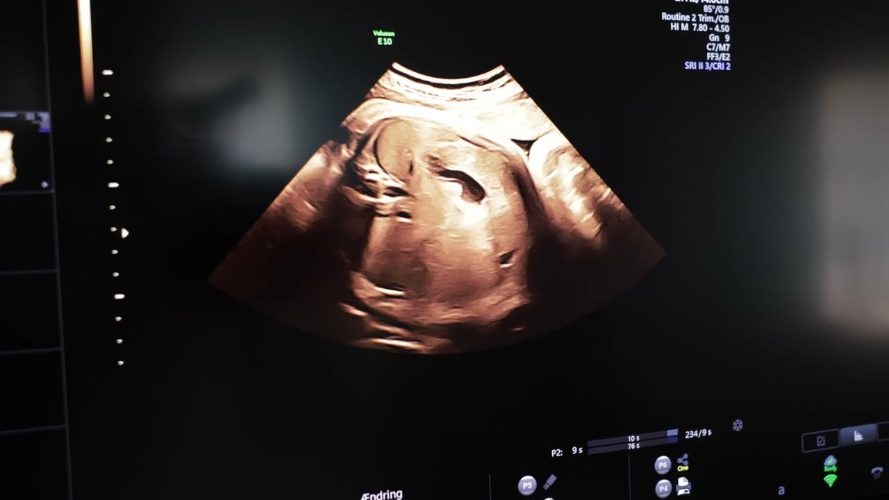 Vægtscanning/tryghedsscanning uge 38 + 3 - Signes jordemoder-og scanningsklinik
