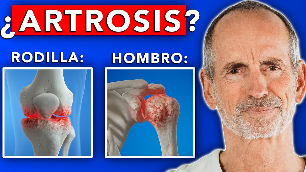NADIE te dice ESTO sobre la ARTROSIS 👌 😃 💯