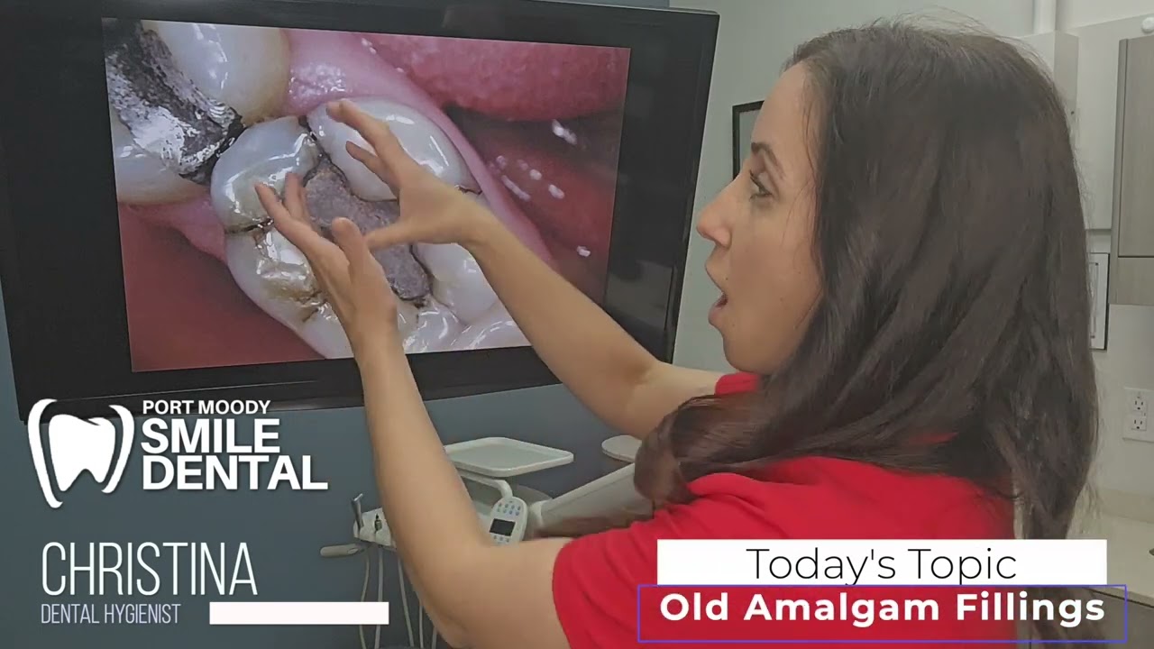 Port Moody Smile Dental - Christina - Old Amalgam Fillings